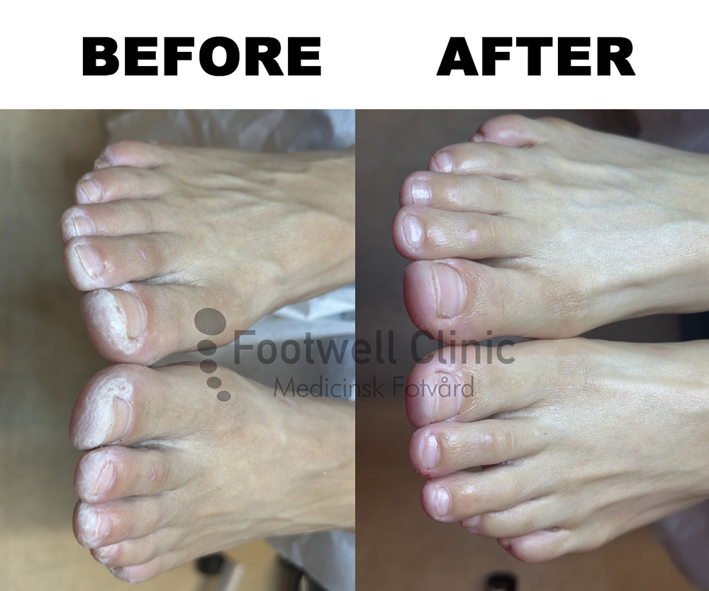 Behandling - före och efter