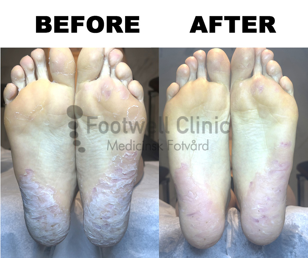 Behandling - före och efter